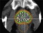 CT scan of prostate following completion of the implant 